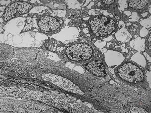 F,31y. | mucoepidermoid carcinoma F,31y. | mucoepidermoid carcinoma